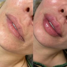 Аугументация губ