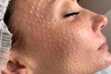 Биоревитализация