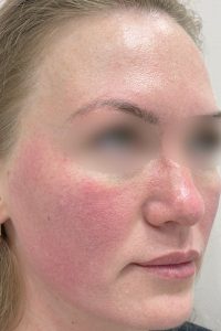 Лечение розацеа лазером в Новосибирске